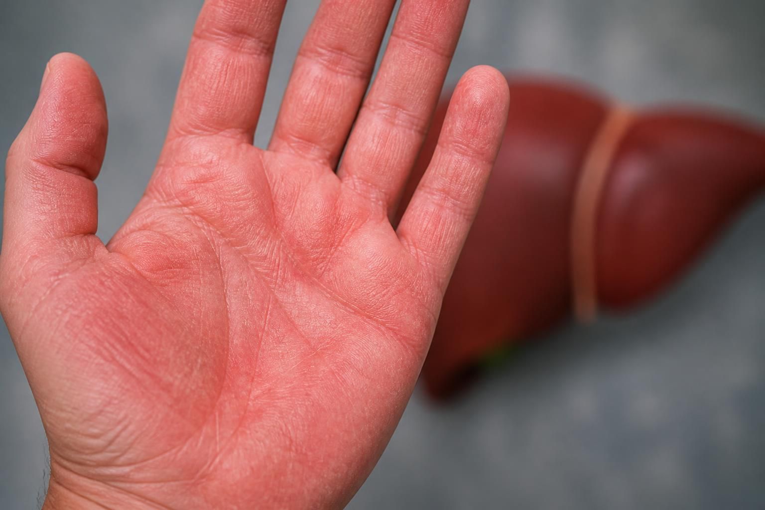 découvrez l'érythrose palmaire : ses causes, ses symptômes et son lien avec les problèmes de foie pour mieux comprendre cette affection cutanée.